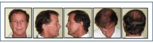 Examples of angles to submit for hair restoration consultation