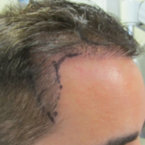 Hair transplant patient 1 - before