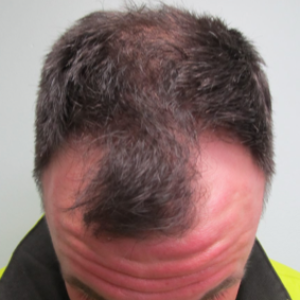 Hair transplant patient 10 - before