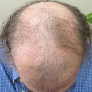 Hair transplant patient 11 - before
