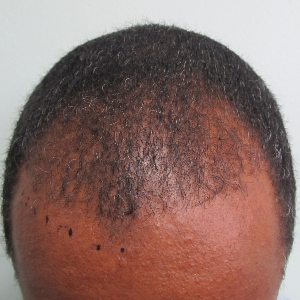 Hair transplant patient 12 - before