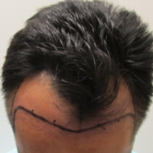 Hair transplant patient 13 - before