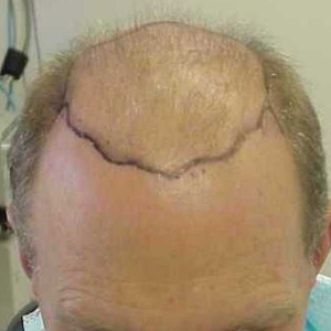 Hair transplant patient 14 - before