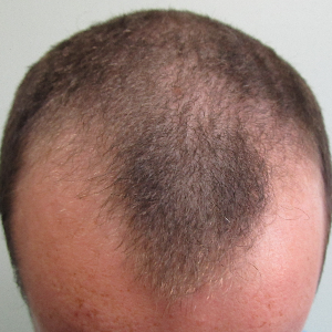 Hair transplant patient 15 - before