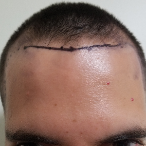 Hair transplant patient 16 - before
