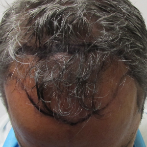 Hair transplant patient 17 - before