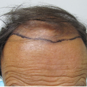 Hair transplant patient 18 - before