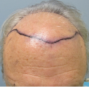 Hair transplant patient 19 - before