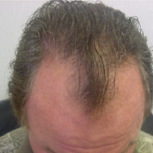 Hair transplant patient 2 - before