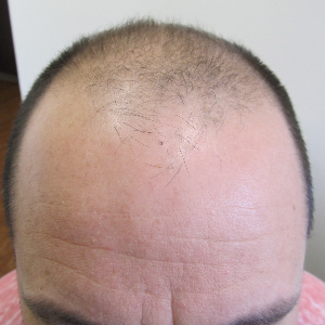 Hair transplant patient 20 - before