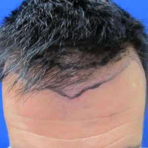 Hair transplant patient 21 - before