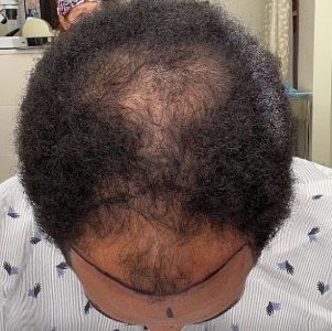 Hair transplant patient 22 - before