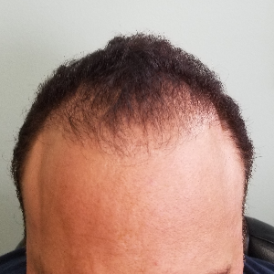 Hair transplant patient 23 - before