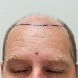 Hair transplant patient 24 - before