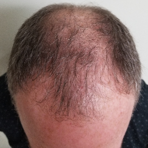 Hair transplant patient 3 - before
