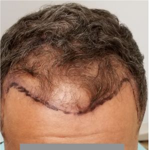 Hair transplant patient 4 - before