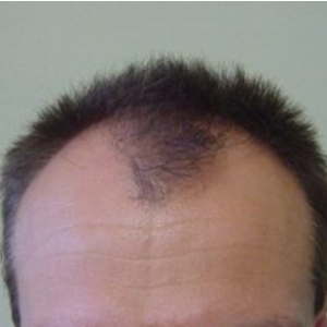 Hair transplant patient 6 - before