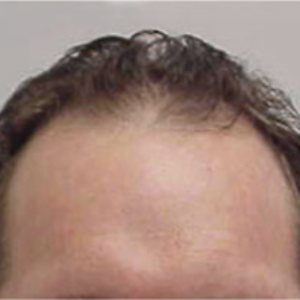 Hair transplant patient 8 - before