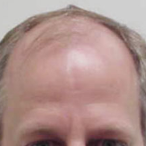 Hair transplant patient 9 - before